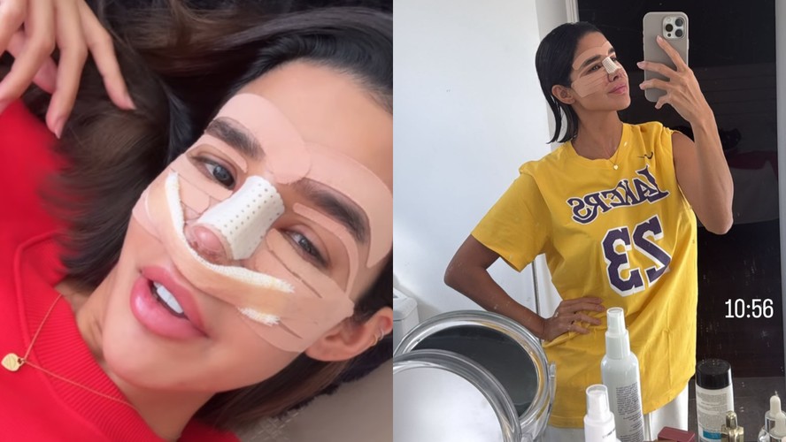 Ex-BBB Kerline aparece com curativos no rosto e fala de pós-operatório ...