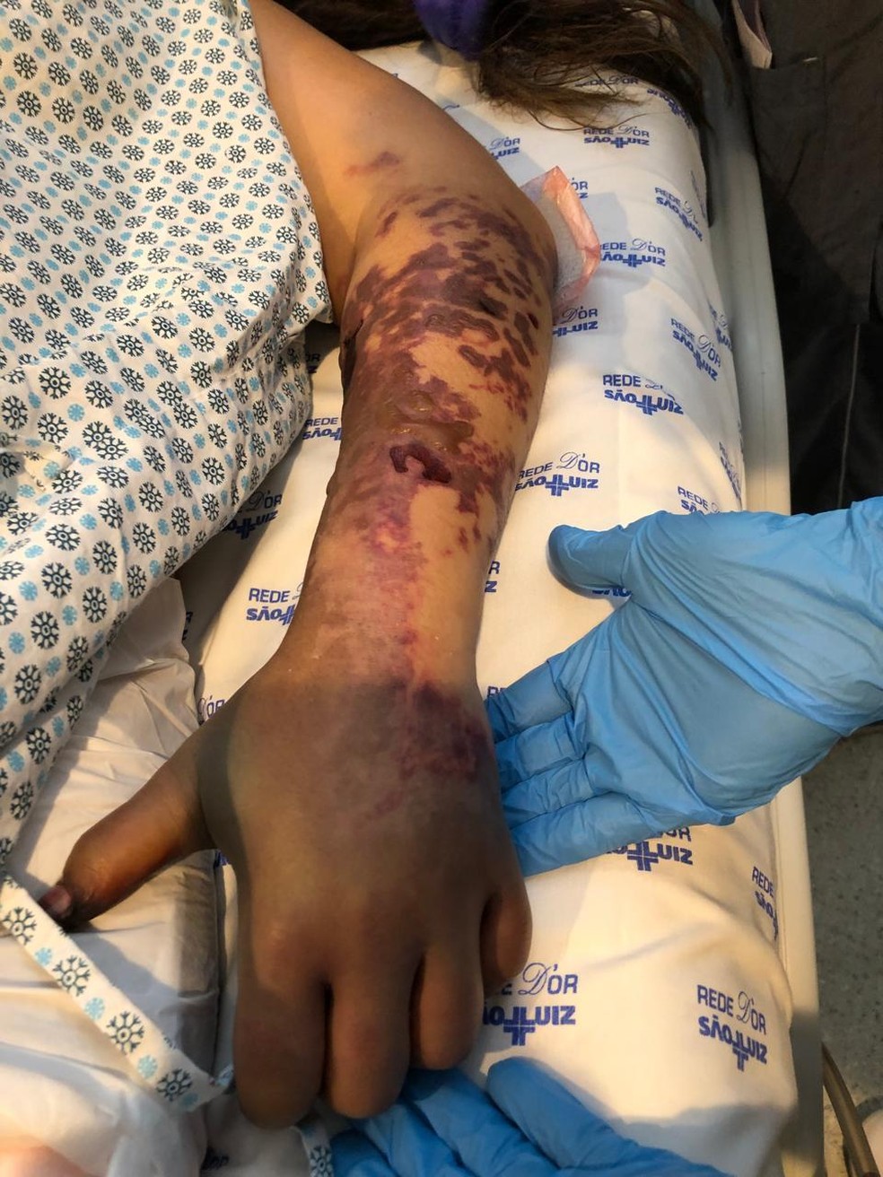 Inicialmente, Thais perderia todo o braço esquerdo. Mas um médico conseguiu salvar seu antebraço — Foto: Arquivo pessoal