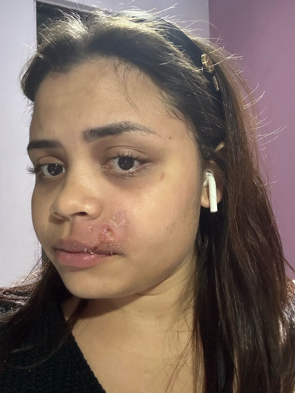 Até o momento, Ana Carolina não fez uso de nenhum tratamento estético para amenizar as marcas da espinha — Foto: Arquivo pessoal
