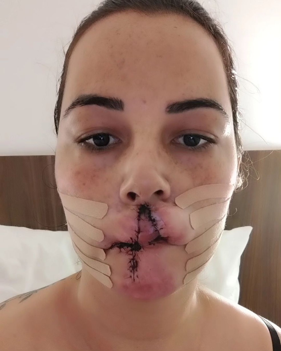 Mariana Michelini após cirurgia de reconstrução — Foto: Reprodução / Instagram