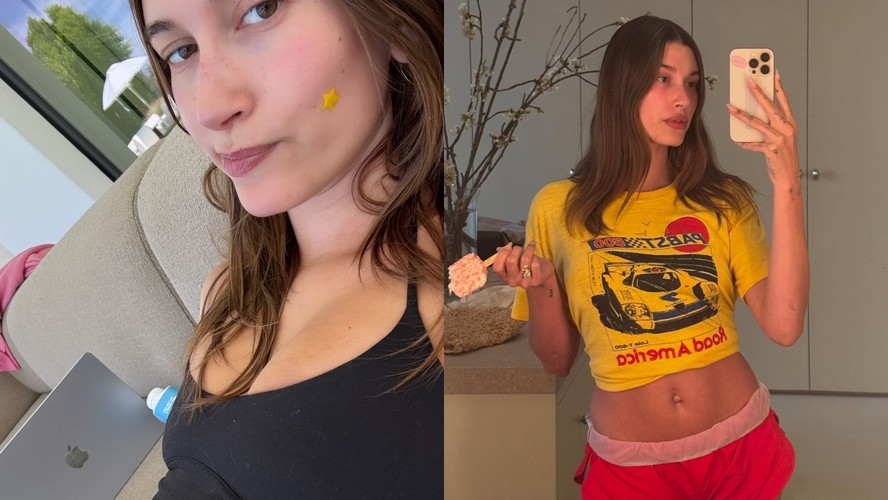 Hailey Bieber revela diagnóstico de 2 cistos no ovário