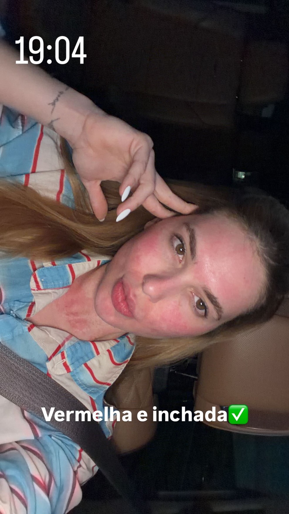 Veja como ficou o rosto de Virginia após o procedimento — Foto: Reprodução/ Instagram @virginia