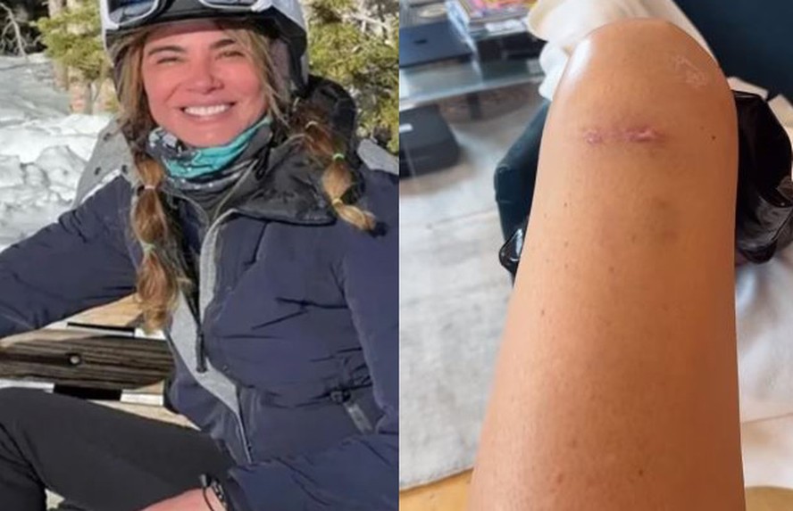 Após cirurgia, Luciana Gimenez mostra cicatrizes na perna