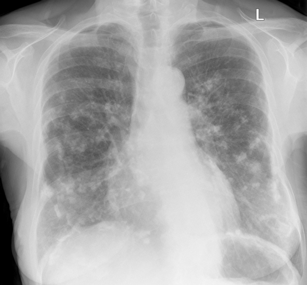 Raio-x do pulmão de uma mulher intoxicada por amianto — Foto: Getty Images