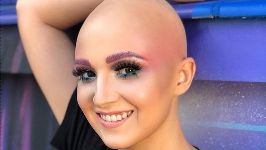 Ana Moreira, de 33 anos, foi diagnosticada com alopecia areata aos 11 anos