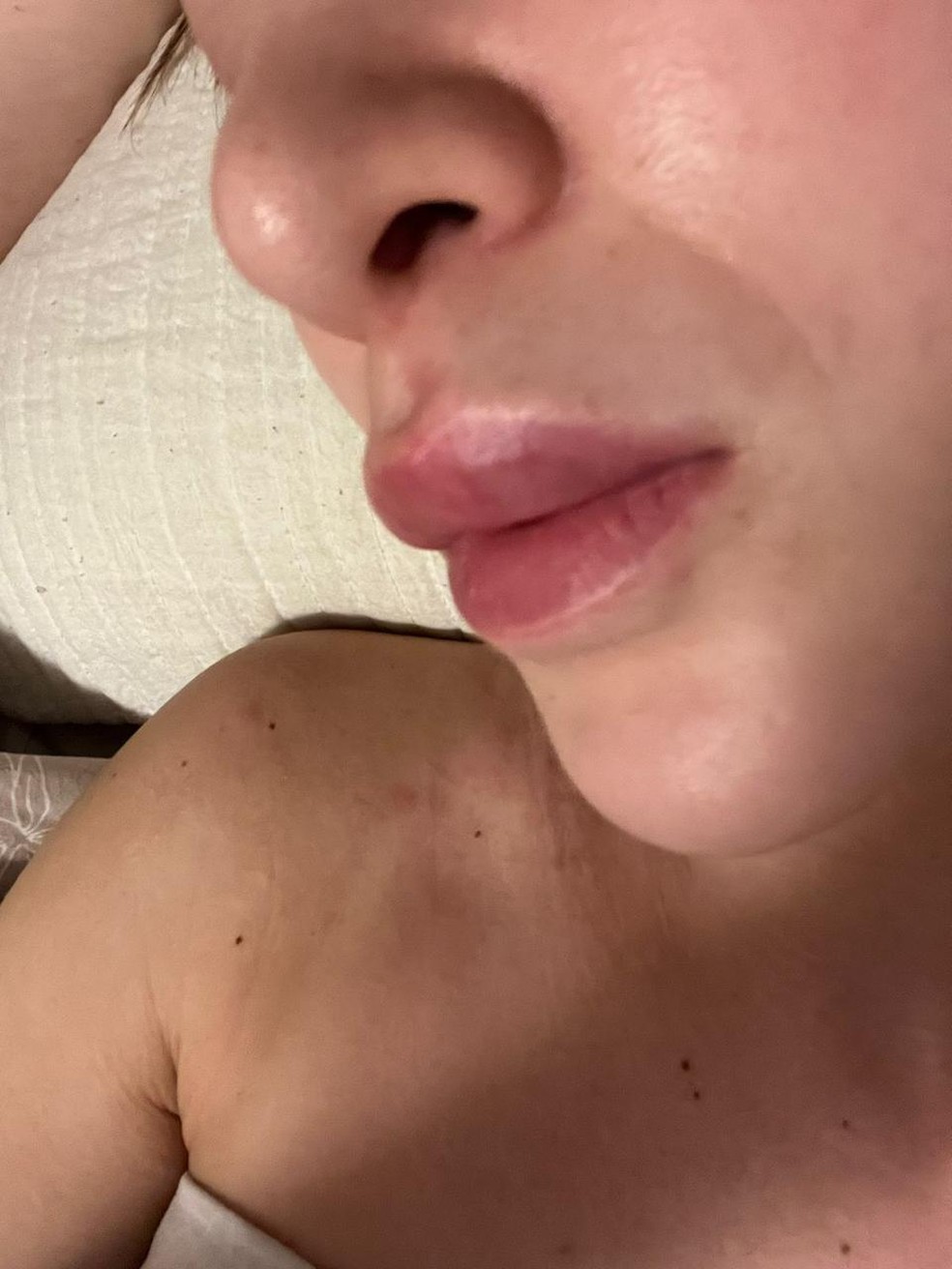 Sem motivo aparente, a médica ficou com a boca inchada — Foto: Arquivo pessoal