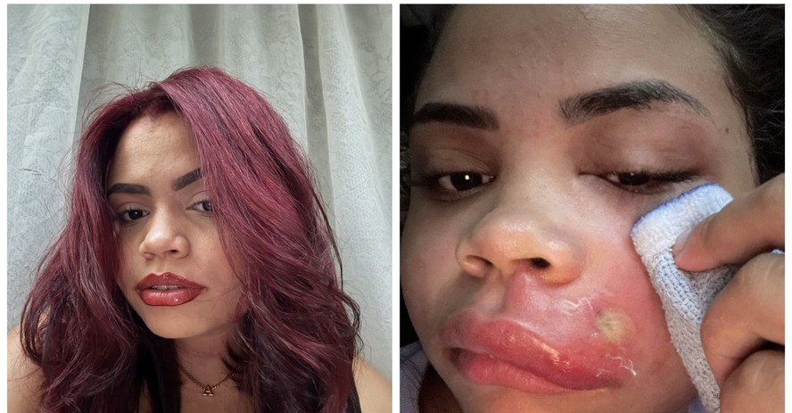 Ana Carolina Alves Cordeiro tomou antibióticos e anti-inflamatório para conter a infecção