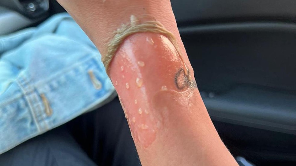 A queimadura de segundo grau atinge a epiderme e parte da derme, formando bolhas — Foto: Arquivo pessoal