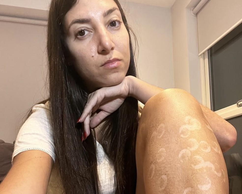 Bárbara Reis, vítima de queimaduras na perna por depilação à laser — Foto: Arquivo Pessoal