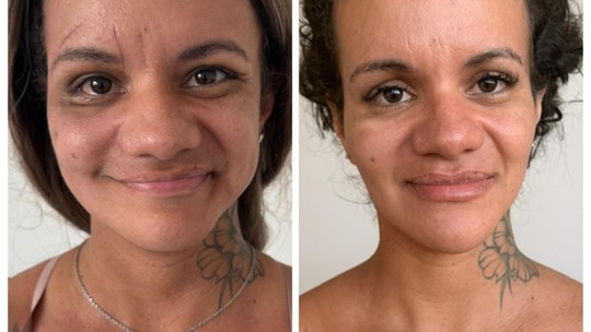 Mulher agredida com 61 socos recupera  mobilidade e simetria no rosto após fisioterapia: 'Eterna gratidão'