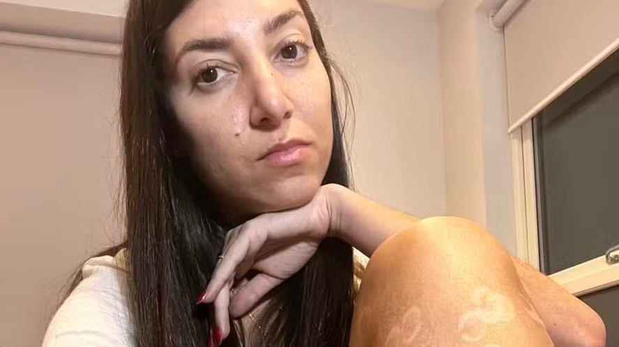 Bárbara Reis, vítima de queimaduras na perna por depilação à laser