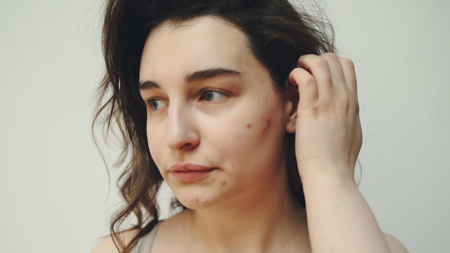 A acne pode ser agravada pelo uso de produtos não indicados para esse tipo de pele