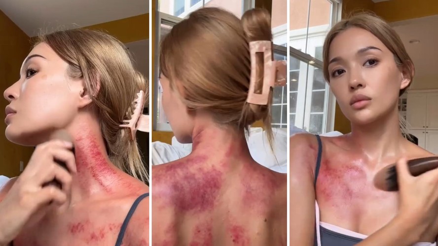 Vermelhidão com o Gua Sha: normal ou preocupante?
