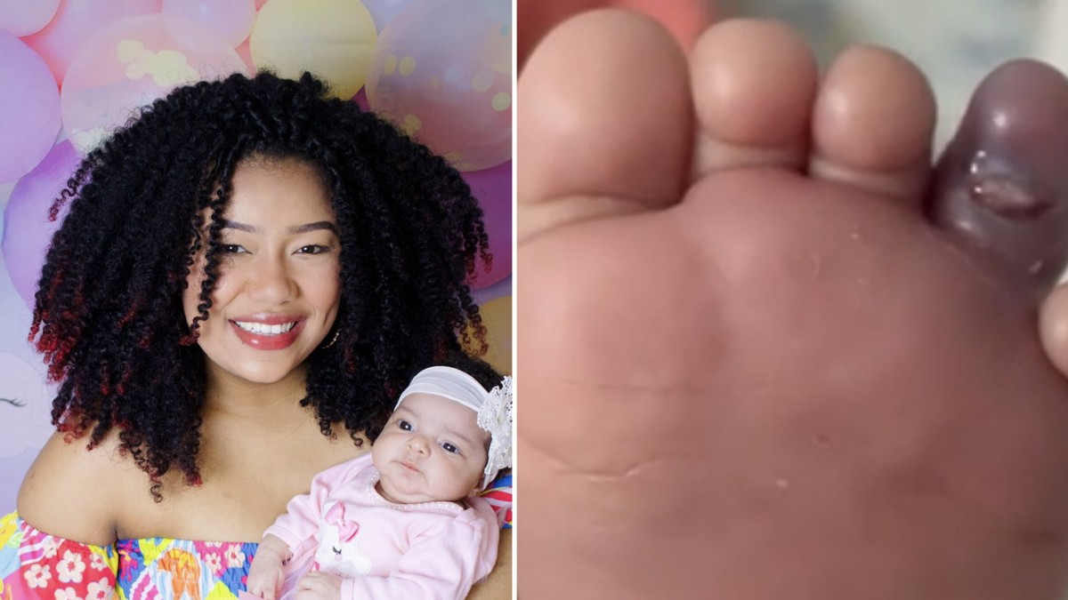 Celulite infecciosa: 'O dedo da minha filha ficou roxo, não parava de ...