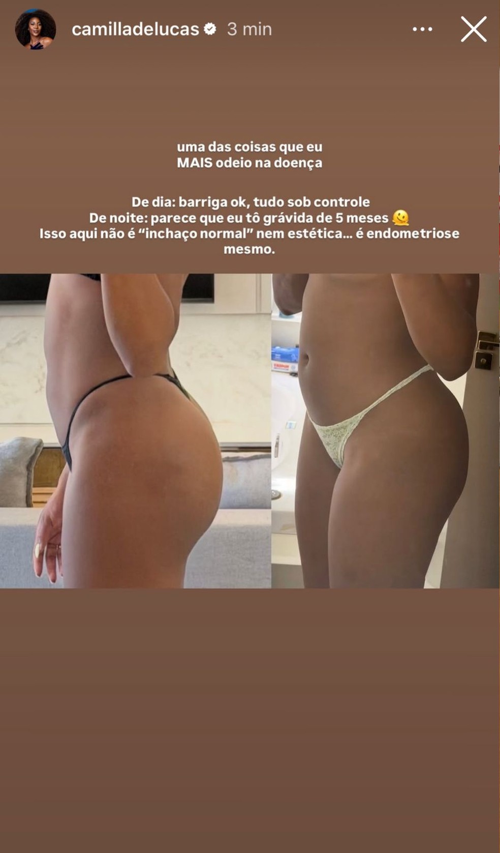 Camilla de Lucas mostra mudanças no corpo causadas pela endometriose — Foto: Reprodução/Instagram