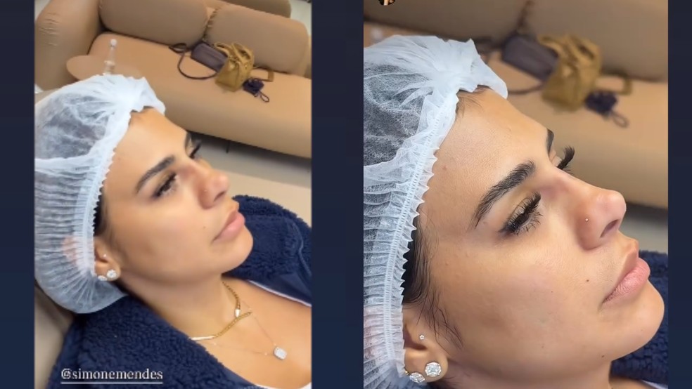 Simone Mendes exibe resultado pr&eacute;vio de procedimento no nariz &mdash; Foto: Reprodu&ccedil;&atilde;o/ Instagram @simonemendes