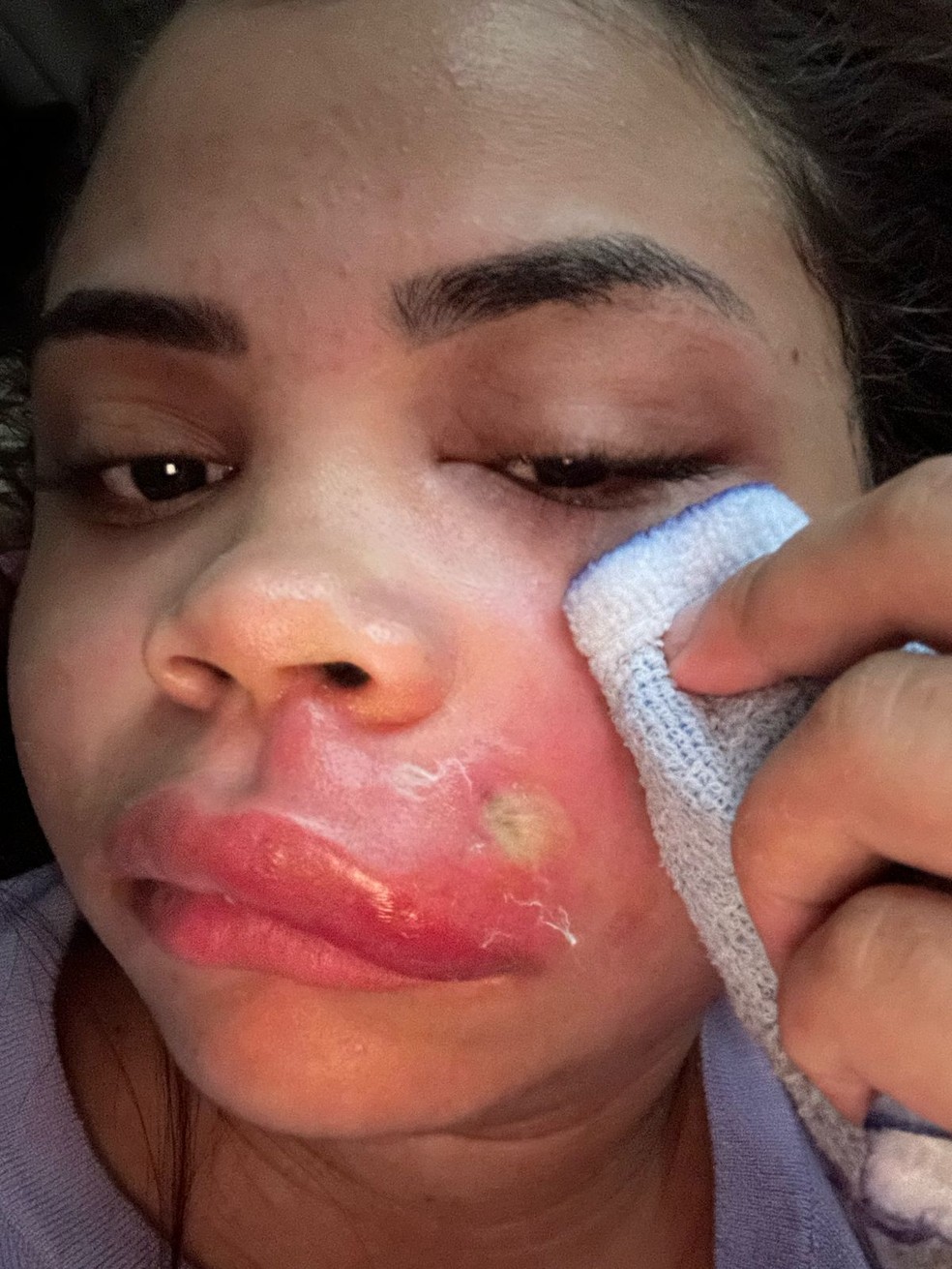 Foi a mãe de Ana Carolina quem aliviou o sofrimento da filha, drenando o pus em casa com os cuidados necessários que conhecia, uma vez que é enfermeira — Foto: Arquivo pessoal