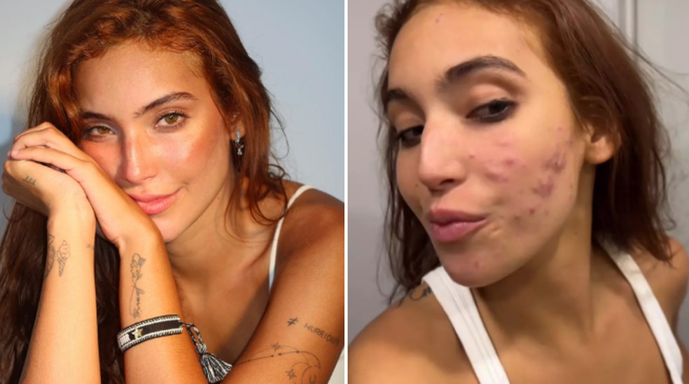 Vanessa Lopes mostra antes e depois de acne severa: 'Lembrete que tudo ...