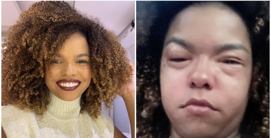 Jeniffer Nascimento desenvolveu alergia alimentar de uma hora para outra