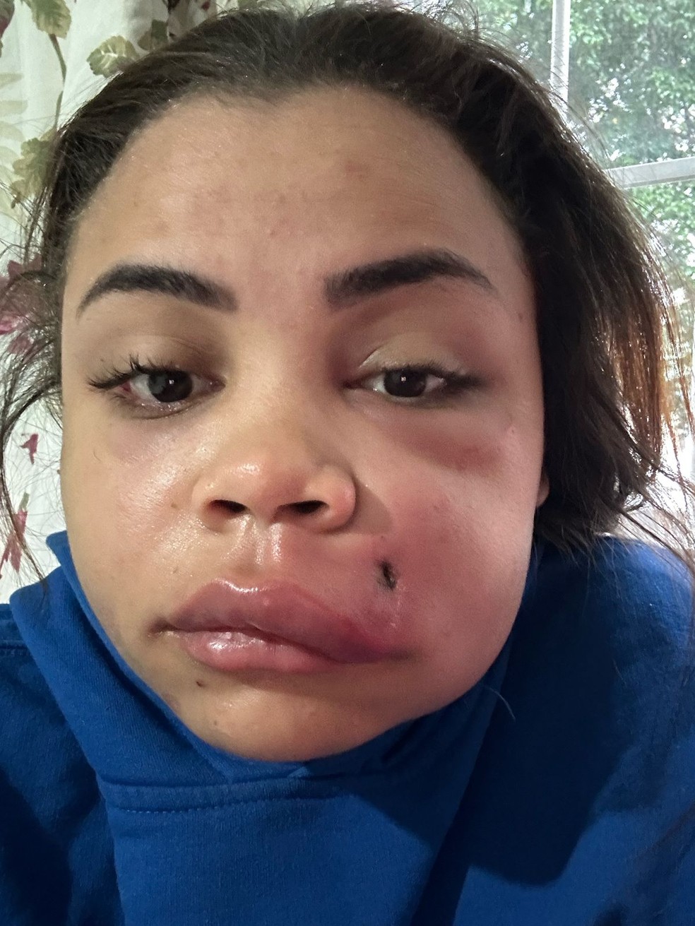Mesmo com o inchaço visível, os médicos se recusaram a drenar o rosto da assistente de marketing — Foto: Arquivo pessoal