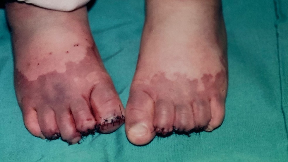 A amputação foi recomendada para evitar infecção generalizada — Foto: Arquivo pessoal